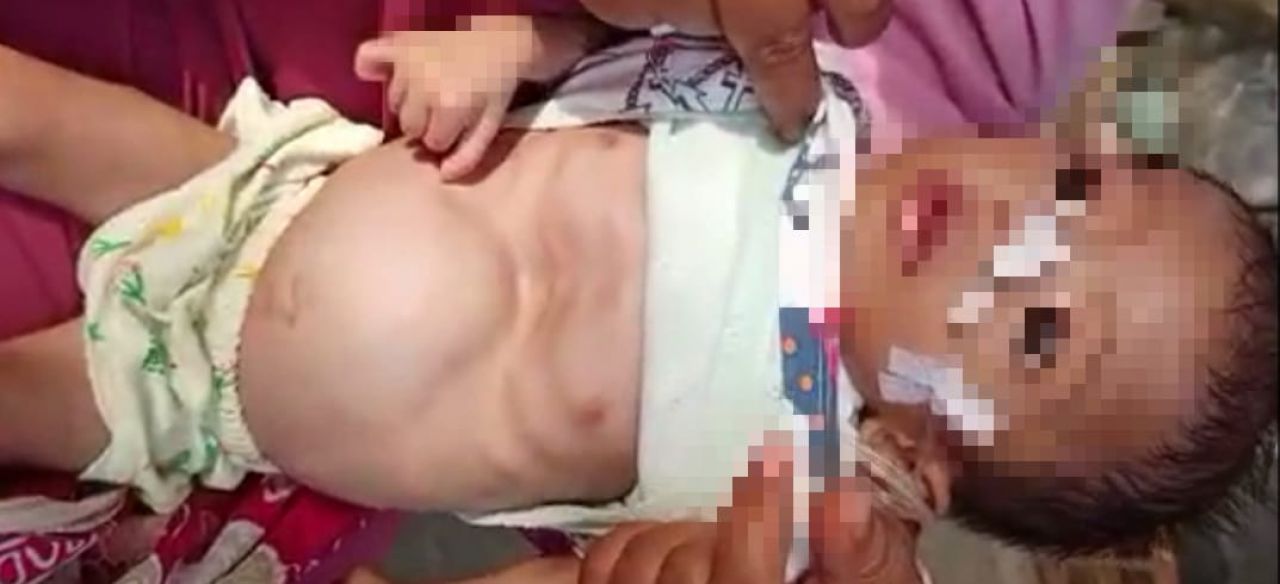 Derita Penyakit Saraf Otak, Yusuf Balita 3 Tahun, Butuh Bantuan Pemerintah Dan Dermawan