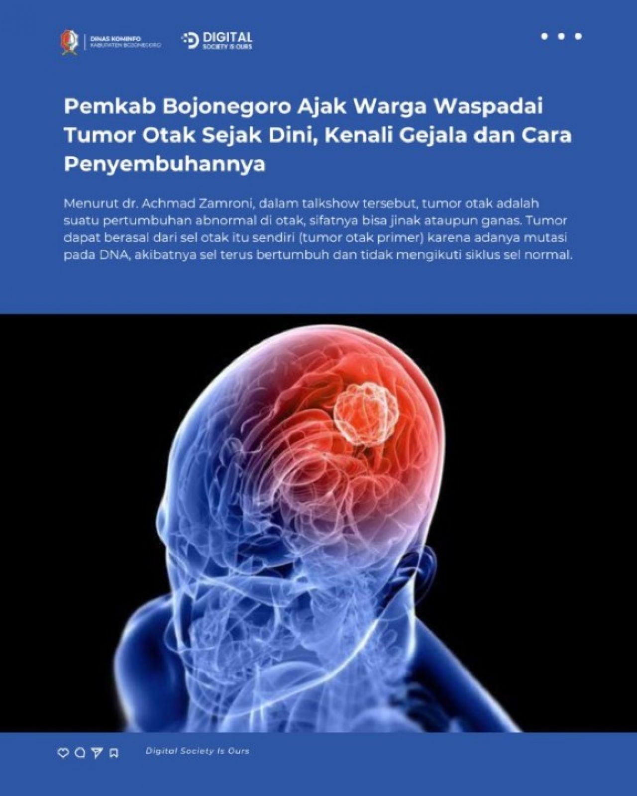 Pemkab Bojonegoro Ajak Warga Waspadai Tumor Otak Sejak Dini, Kenali Gejala dan Cara Penyembuhannya